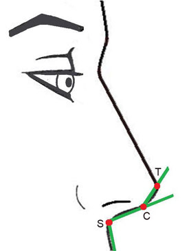 Columella double break
