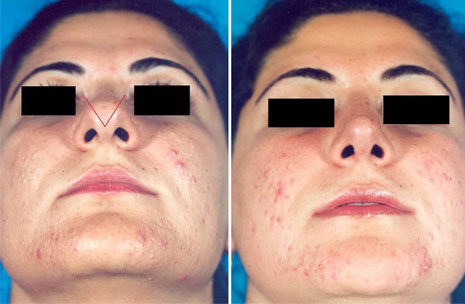 Angle of divergence photos 1