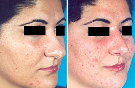 Angle of divergence photos 2