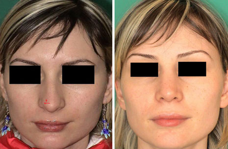 Bulbous tip photos 1