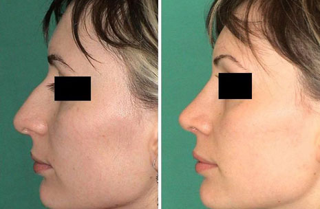 Bulbous tip photos 2