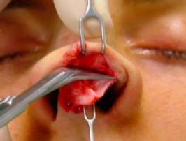 Dissection of the nasal tip in the supraperichondrial plane 3