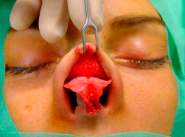 Full exposer of the nasal tip