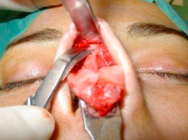 Elevation of the SMAS