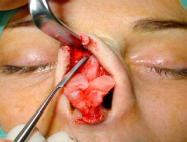 Elevation of the periosteum until the nasion, with two paralateral subperiosteal tunnels 1