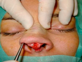 Elevation of the periosteum until the nasion, with two paralateral subperiosteal tunnels 2