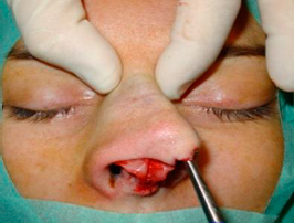 Elevation of the periosteum until the nasion, with two paralateral subperiosteal tunnels 3