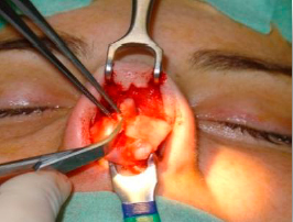 Creation of subperichondrial tunnels, beneath the angle formed by the septum and the ULC
