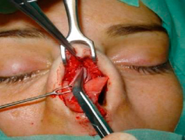 Creation of subperichondrial tunnels, beneath the angle formed by the septum and the ULC 2