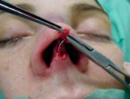 Subcutaneous suture, with PDS stich at midline