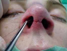 Subcutaneous suture, with PDS stich at midline 2