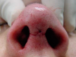 Final aspect, after closure of the cutaneous plane with nylon 6/0 suture 1