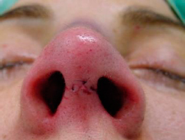 Final aspect, after closure of the cutaneous plane with nylon 6/0 suture 2