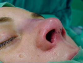 Final aspect, after closure of the cutaneous plane with nylon 6/0 suture 3