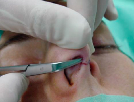 Dissection with Converse scissor.