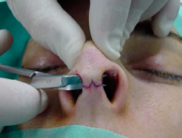 Dissection with Converse scissor. 2