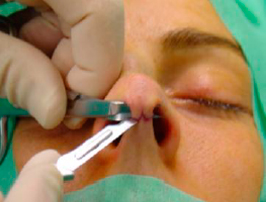 Completing the incision while protecting the medial crura