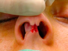 Completing the incision while protecting the medial crura 2