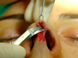 The supraperichondrial plane