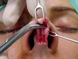 Dissection of the nasal tip in the supraperichondrial plane 1