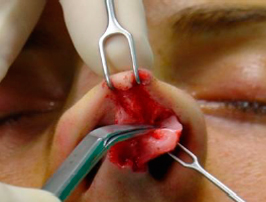 Dissection of the nasal tip in the supraperichondrial plane 2