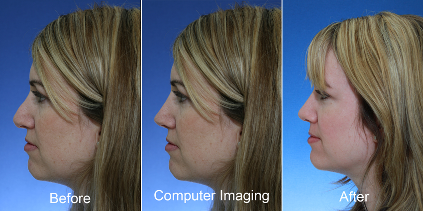 before rhinoplasty (left), the digitally morphed image during the consultation