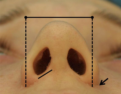 The ala abuts the nasal tip anteriorly and the nasal sidewall superiorly