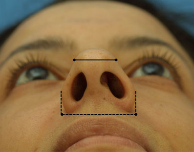 The width of the lobule or superior one-third of the base view is about 75 percent of the entire nasal base width