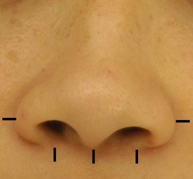 The nasal base is locally injected with Xylocaine 1% with 1:100,000 Epinephrine, buffered 9:1 with 8.4%