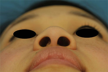 Combined Correction of Both Wide Nostril Sills