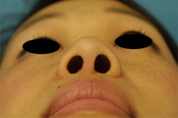 Combined Correction of Both Wide Nostril Sills 2