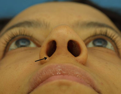 Notching of the alar rim or nostril sill is the most reported complication.