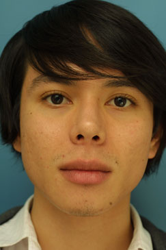 Post-operative Follow-up 1