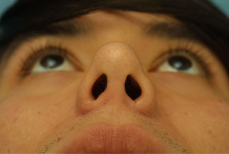 Post-operative Follow-up 6