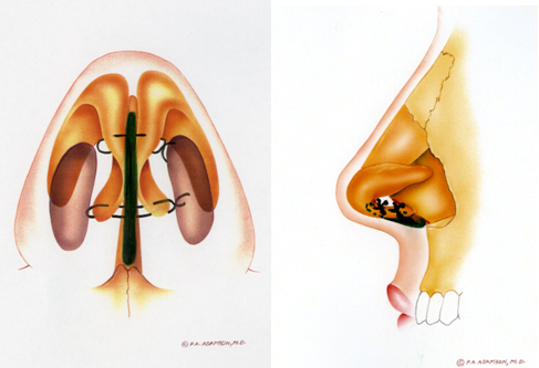 Columellar strut: Lengthener and strengthener of nasal tip