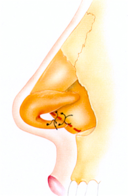 Septocolumellar suture (Tongue-In-Groove)