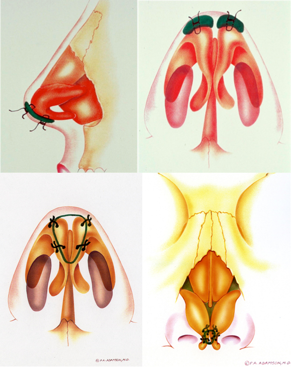 Infratip lobule graft will effect projection, counterrotation, and lobule refinement