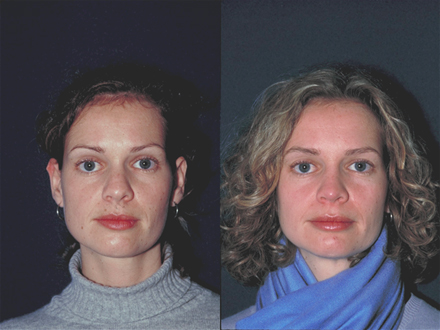 Photographs demonstrating pre (A, C, E) and 1 year postoperative Frontal