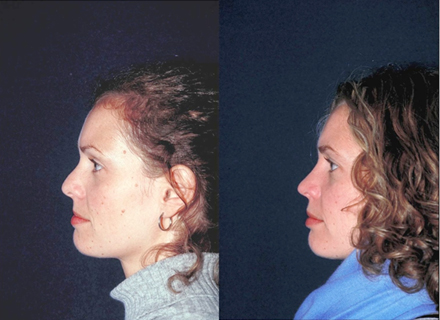 Photographs demonstrating pre (A, C, E) and 1 year postoperative lateral