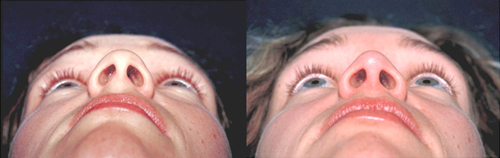 Photographs demonstrating pre (A, C, E) and 1 year postoperative Base