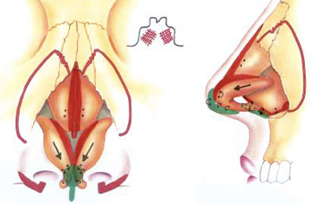 Photographs demonstrating pre (A, C, E) and 1 year postoperative Diagram