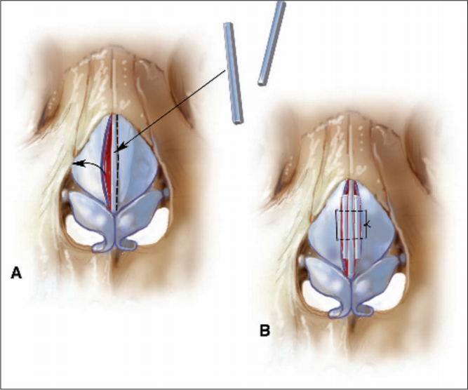 Surgical Treatment of Nasal Obstruction in Rhinoplasty