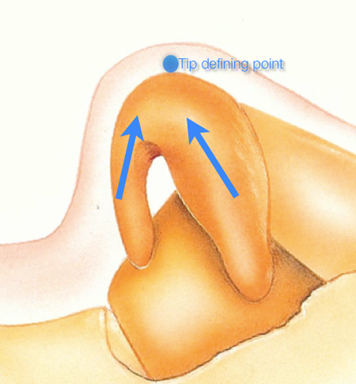 Dynamics of the M-Arch showing the thrusting forces (arrows) that define the dynamics of the lower lateral cartilages