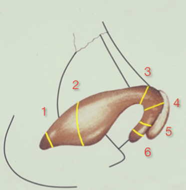 Vertical arch division (VAD):  May be performed anywhere along the M-Arch