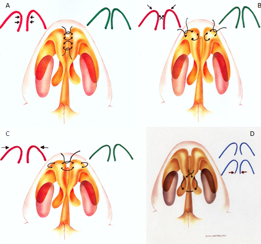 Tip suturing techniques