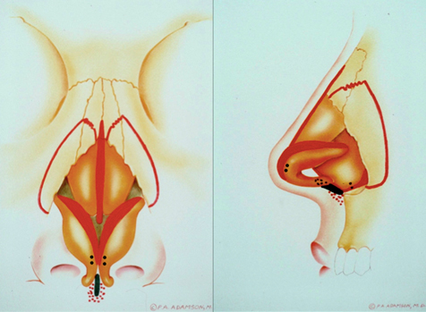 Postoperative photographs demonstrate improved lobular refinement