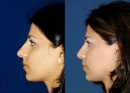 Rhinoplasty diagram (G) demonstrates vertical lobular division Lateral