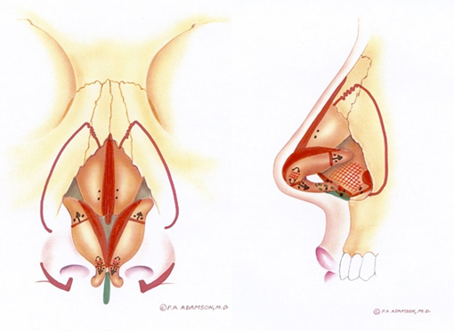 Rhinoplasty diagram (G) demonstrates vertical lobular division