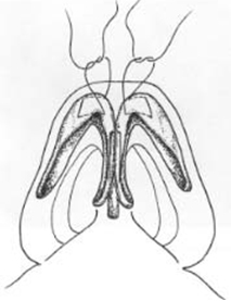 Individual horizontal mattress domal sutures 1