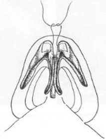 Individual horizontal mattress domal sutures 2